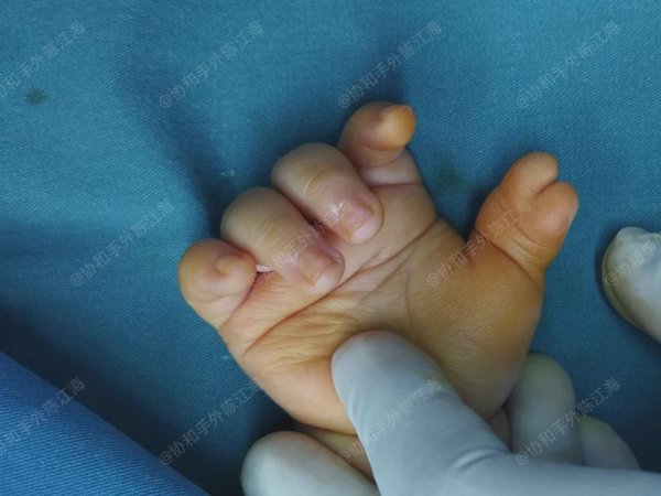 聚美策略 多指│案例36《外公外婆不敢碰宝宝的手，关上门让我一个人狠心》